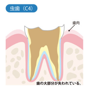 東京の根管治療専門外来、笠原デンタルオフィスで、神経を抜いた歯がしみるのはなぜ？冷たいもの・熱いもので痛む原因と抜歯を防ぐ治療法を解説