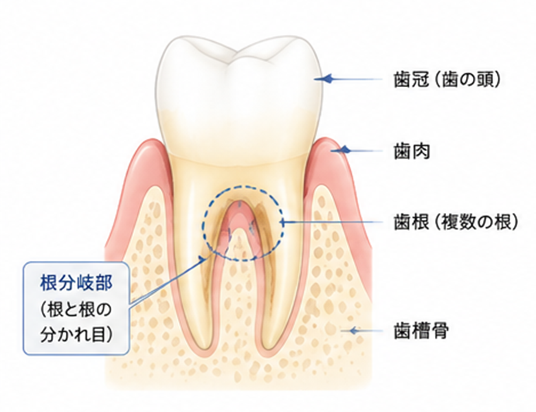 治療が難しいと言われる「根分岐部病変」とは？原因を突き止め、保存を