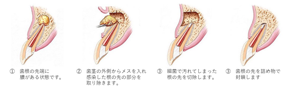 東京の根管治療専門外来、笠原デンタルオフィスで、せっかく入れたセラミックの歯がまた痛む？再根管治療が必要な理由と壊さずに残す選択肢