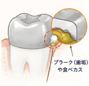 東京の根管治療専門外来、笠原デンタルオフィスで、銀歯の周りが臭う・生臭いのはなぜ？磨いても消えないニオイの原因と解決法