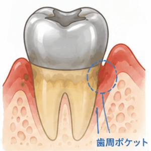 東京の根管治療専門外来、笠原デンタルオフィスで、銀歯の周りが臭う・生臭いのはなぜ？磨いても消えないニオイの原因と解決法